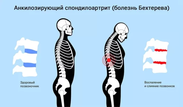 Рискнул здоровьем. Ученый испытал на себе препарат от неизлечимой болезни